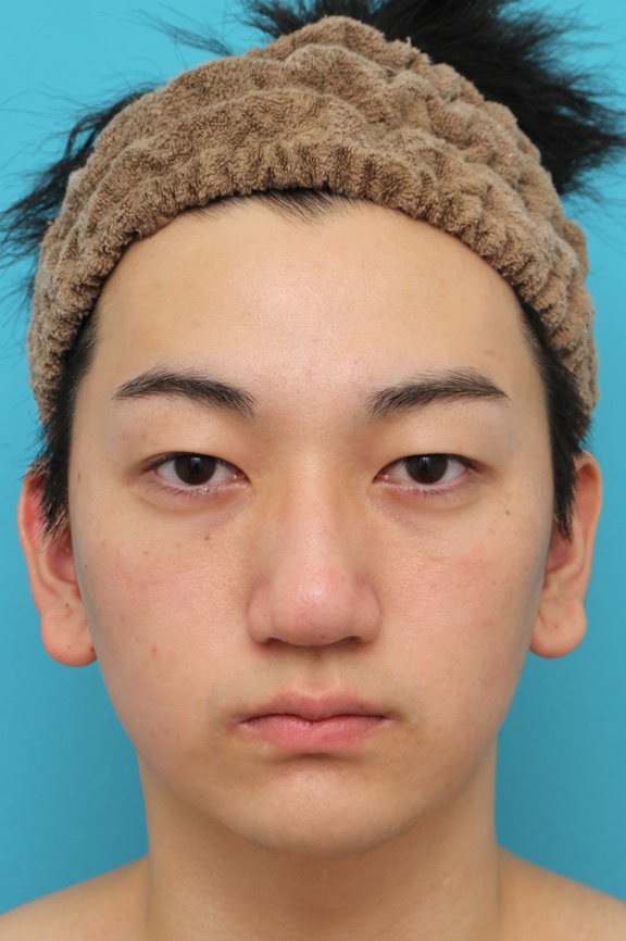 垂れ鼻修正手術,垂れ鼻修正+鼻尖縮小+小鼻縮小を行った20代男性の症例写真,3週間後,mainpic_tarebana002d.jpg