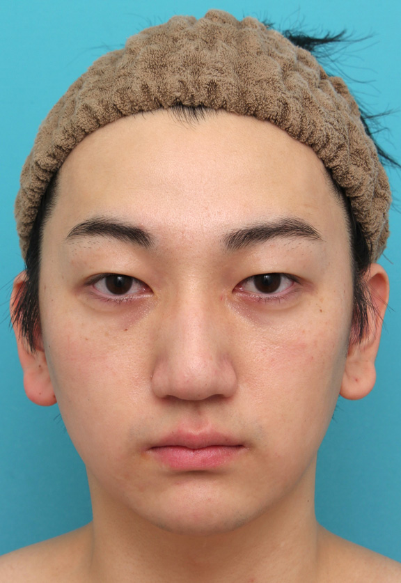 垂れ鼻修正手術,垂れ鼻修正+鼻尖縮小+小鼻縮小を行った20代男性の症例写真,6ヶ月後,mainpic_tarebana002e.jpg