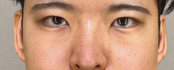 立ち耳修正＋二重まぶた・埋没法（一針固定）を行った症例写真,After（6ヶ月後）,ba_tachimimi001_a01.jpg