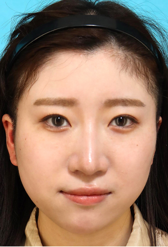 鼻筋のシリコンプロテーゼ+鼻先の耳介軟骨移植+小鼻縮小を行った20代女性の症例写真,After（3ヶ月後）,ba_ryubi1066_a01.jpg