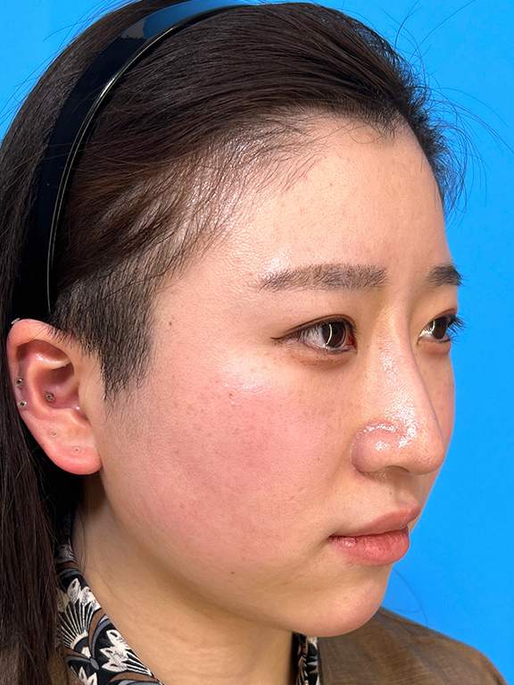症例写真,鼻筋のシリコンプロテーゼ+鼻先の耳介軟骨移植+小鼻縮小を行った20代女性の症例写真,After（3ヶ月後）,ba_ryubi1066_b02.jpg