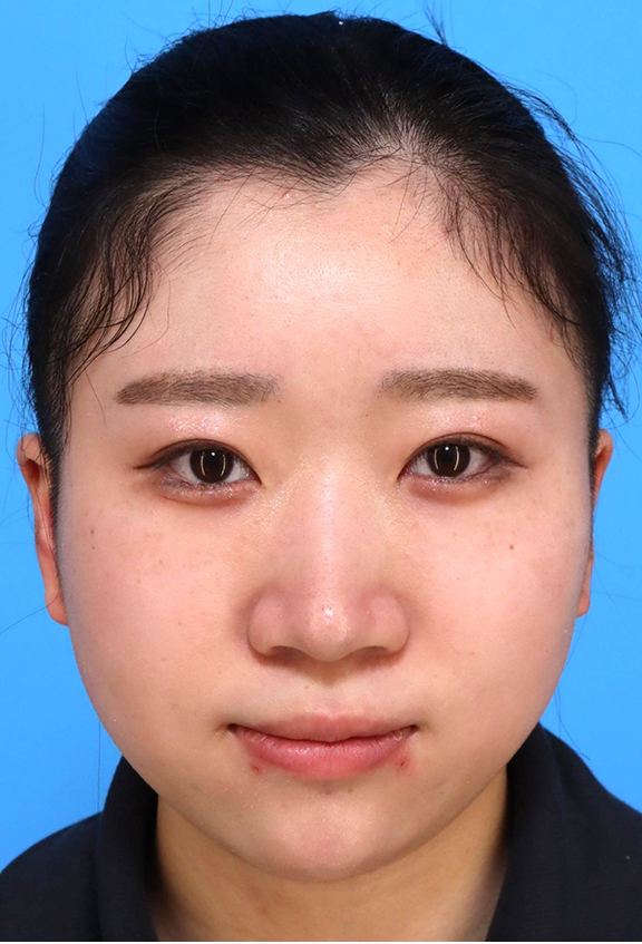 鼻筋のシリコンプロテーゼ+鼻先の耳介軟骨移植+小鼻縮小を行った20代女性の症例写真,Before,ba_ryubi1066_b01.jpg