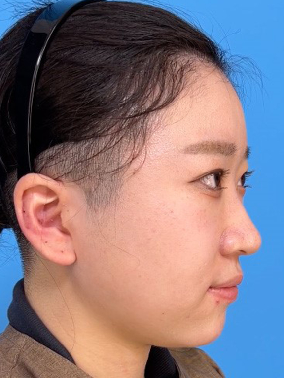 症例写真,鼻筋のシリコンプロテーゼ+鼻先の耳介軟骨移植+小鼻縮小を行った20代女性の症例写真,Before,ba_ryubi1066_b02.jpg