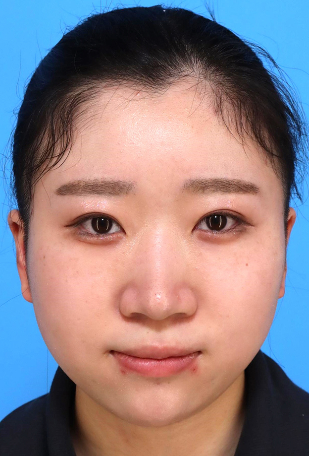 症例写真,鼻筋のシリコンプロテーゼ+鼻先の耳介軟骨移植+小鼻縮小を行った20代女性の症例写真,手術前,mainpic_ryubi1066a.jpg