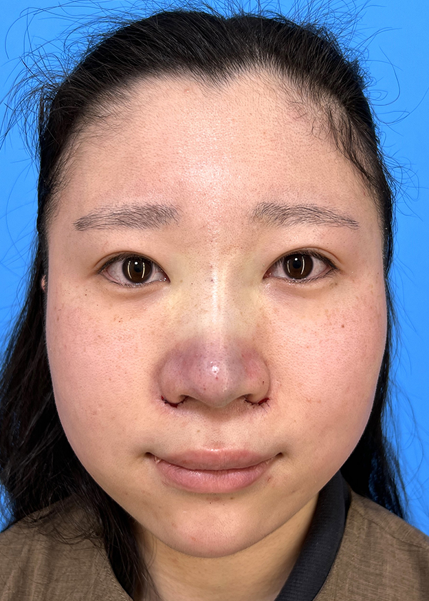 症例写真,鼻筋のシリコンプロテーゼ+鼻先の耳介軟骨移植+小鼻縮小を行った20代女性の症例写真,手術直後,mainpic_ryubi1066b.jpg