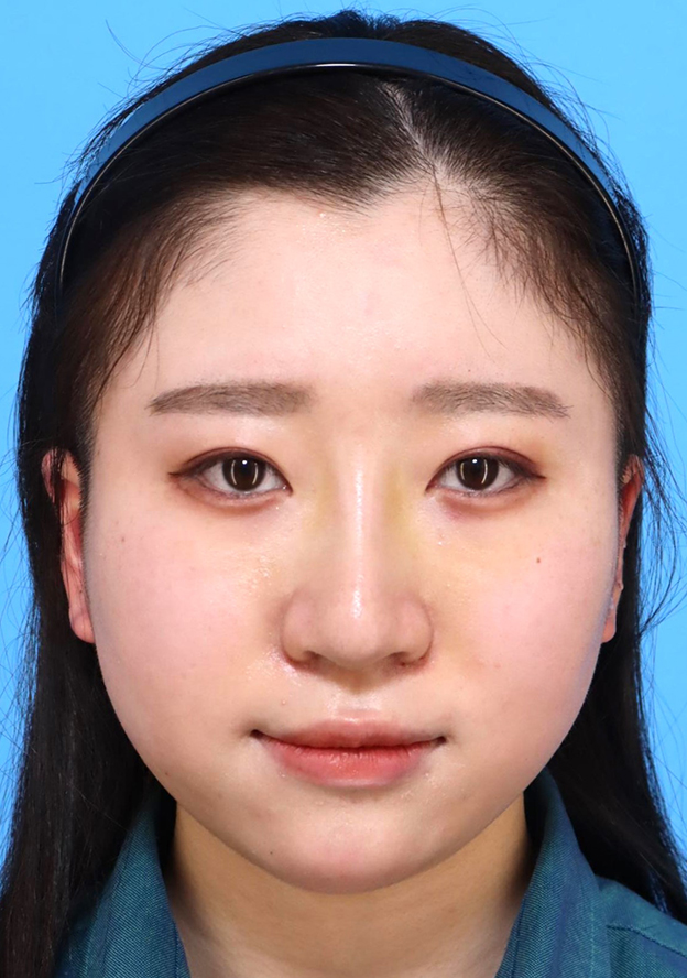 症例写真,鼻筋のシリコンプロテーゼ+鼻先の耳介軟骨移植+小鼻縮小を行った20代女性の症例写真,1週間後,mainpic_ryubi1066c.jpg
