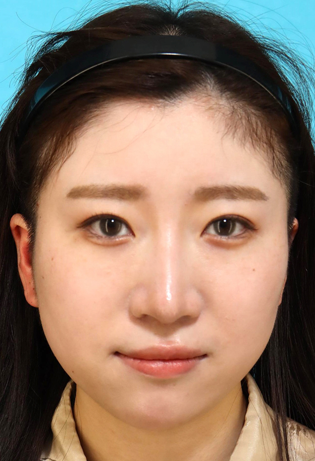 症例写真,鼻筋のシリコンプロテーゼ+鼻先の耳介軟骨移植+小鼻縮小を行った20代女性の症例写真,3ヶ月後,mainpic_ryubi1066d.jpg
