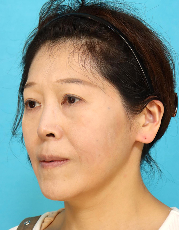 鼻翼基部プロテーゼ（貴族手術）,鼻翼基部プロテーゼ（貴族手術）で中顔面の陥没を改善し、法令線が浅くなった症例写真,After（6ヶ月後）,ba_biyokukibu001_b02.jpg