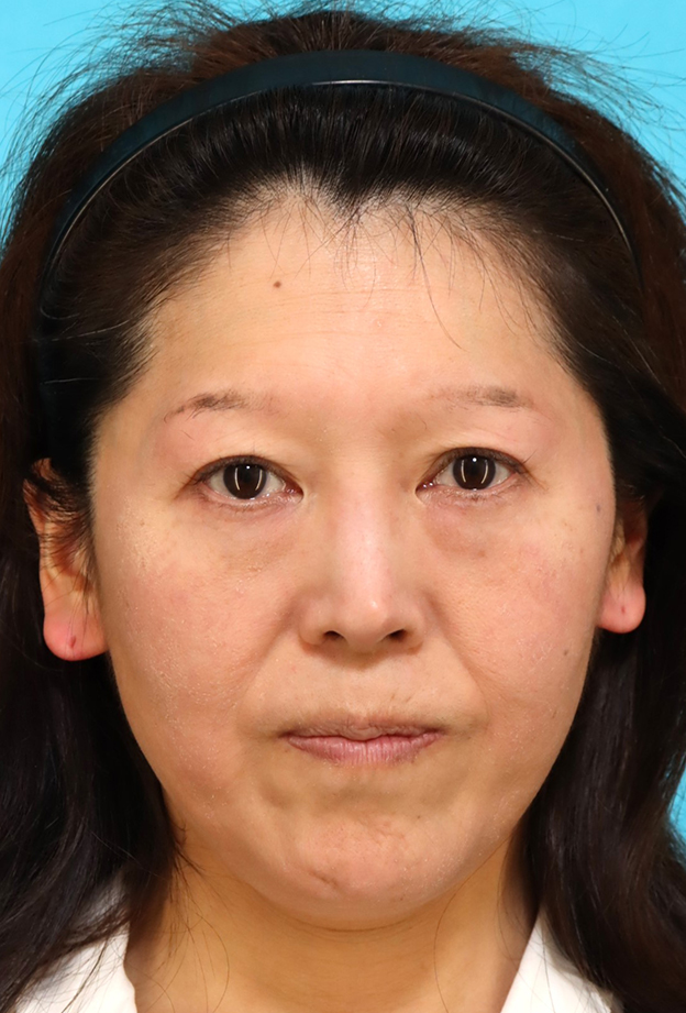 鼻翼基部プロテーゼ（貴族手術）,鼻翼基部プロテーゼ（貴族手術）で中顔面の陥没を改善し、法令線が浅くなった症例写真,手術前,mainpic_biyokukibu001a.jpg