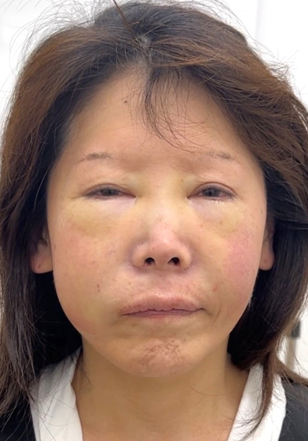 鼻翼基部プロテーゼ（貴族手術）,鼻翼基部プロテーゼ（貴族手術）で中顔面の陥没を改善し、法令線が浅くなった症例写真,手術直後,mainpic_biyokukibu001b.jpg