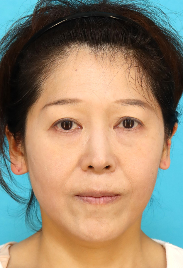 鼻翼基部プロテーゼ（貴族手術）,鼻翼基部プロテーゼ（貴族手術）で中顔面の陥没を改善し、法令線が浅くなった症例写真,6ヶ月後,mainpic_biyokukibu001d.jpg
