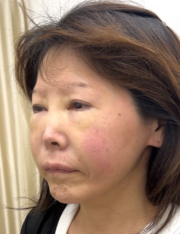 鼻翼基部プロテーゼ（貴族手術）,鼻翼基部プロテーゼ（貴族手術）で中顔面の陥没を改善し、法令線が浅くなった症例写真,手術直後,mainpic_biyokukibu001f.jpg