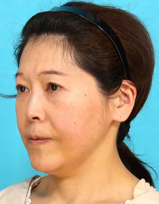 鼻翼基部プロテーゼ（貴族手術）,鼻翼基部プロテーゼ（貴族手術）で中顔面の陥没を改善し、法令線が浅くなった症例写真,1週間後,mainpic_biyokukibu001g.jpg