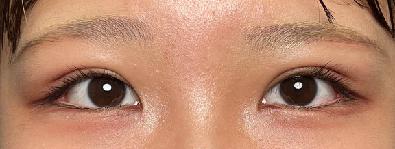 症例写真,10代女性に連続埋没法で二重を作った症例写真,After(メイクあり)<br/>
(1ヶ月後),