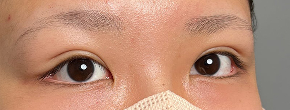 症例写真,10代女性に連続埋没法で二重を作った症例写真,After(1ヶ月後),ba_maibotsu3002_b02.jpg
