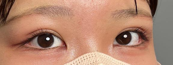 症例写真,10代女性に連続埋没法で二重を作った症例写真,After(メイクあり)<br/>
(1ヶ月後),