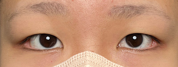症例写真,10代女性に連続埋没法で二重を作った症例写真,施術前,mainpic_maibotsu3002a.jpg