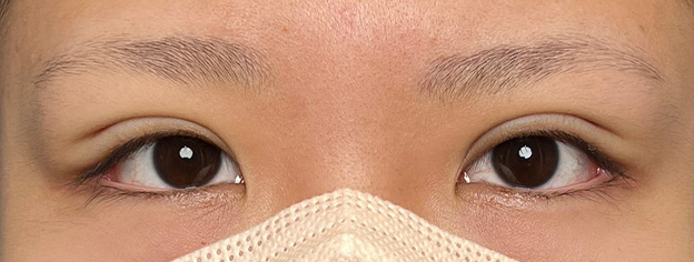 症例写真,10代女性に連続埋没法で二重を作った症例写真,施術直後,mainpic_maibotsu3002b.jpg
