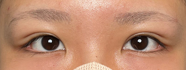 症例写真,10代女性に連続埋没法で二重を作った症例写真,1ヶ月後,メイクなし,mainpic_maibotsu3002c.jpg