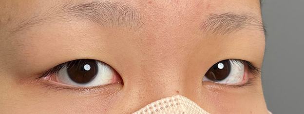 症例写真,10代女性に連続埋没法で二重を作った症例写真,施術前,mainpic_maibotsu3002e.jpg