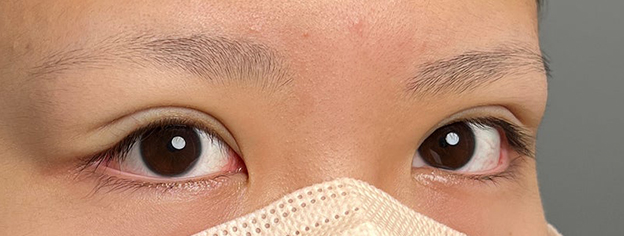 症例写真,10代女性に連続埋没法で二重を作った症例写真,施術直後,mainpic_maibotsu3002f.jpg
