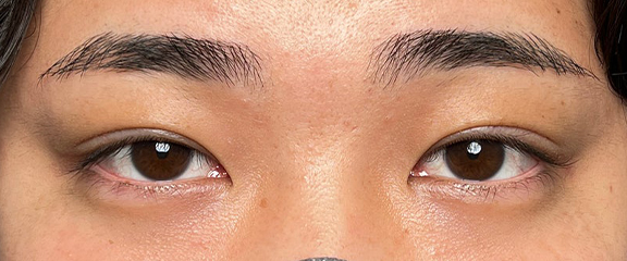 二重まぶた・連続埋没法,連続埋没法で二重を作った男性の症例写真,After（1ヶ月後）,ba_maibotsu3003_a01.jpg