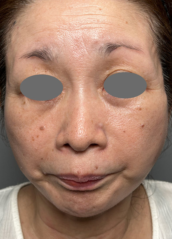 ミニ切開リフトを行った症例写真,After（6ヶ月後）,ba_minilift022_a01.jpg