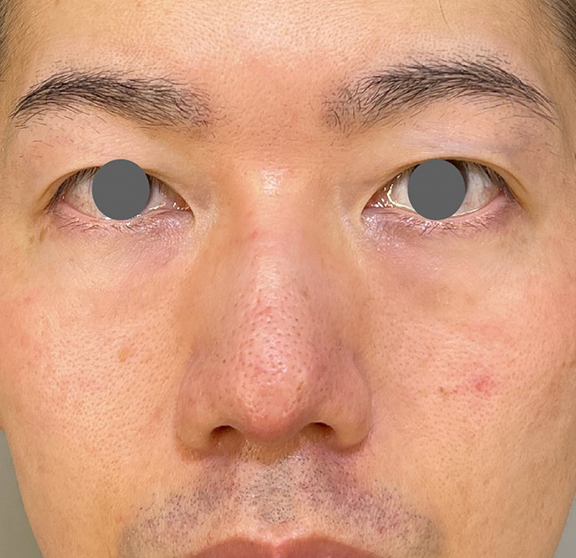 症例写真,耳介軟骨移植で鼻柱を下げた症例写真,After,ba_jikai055_b01.jpg