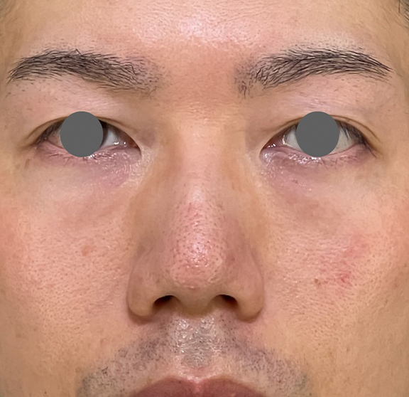 症例写真,耳介軟骨移植で鼻柱を下げた症例写真,Before,ba_jikai055_b01.jpg