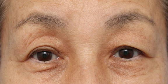 眉下リフトで外側の瞼のたるみを減らした症例写真,Before,ba_jougankenlift013_b01.jpg
