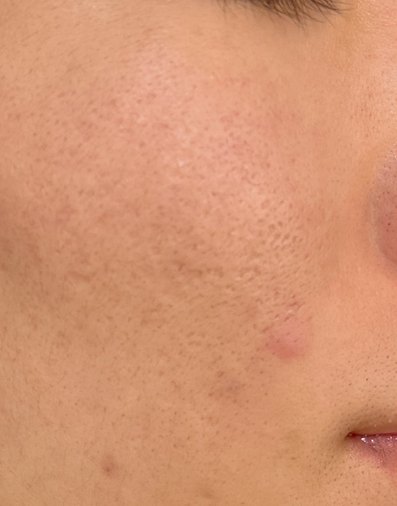 症例写真,サブシジョン＋ジュベルックの症例写真,After（2ヶ月後）,ba_subcision_juvelook001_b01.jpg