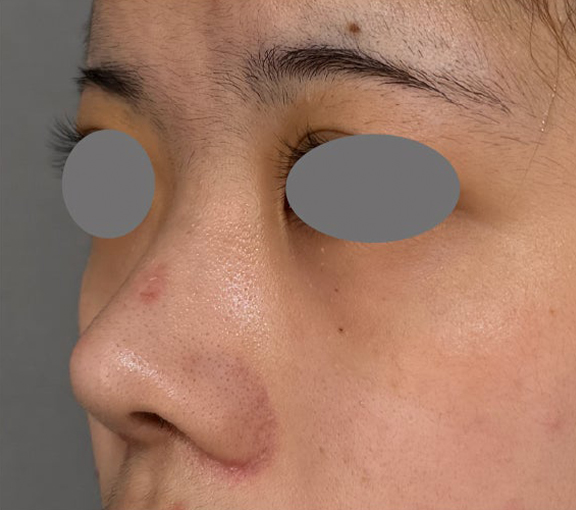 鼻尖形成（鼻尖縮小・だんご鼻修正）,耳介軟骨移植・小鼻縮小・鼻尖形成を行って洗練された印象の鼻になった症例写真,After（2ヶ月後）,ba_jikai058_b02.jpg