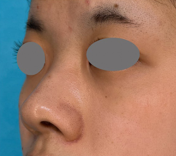 鼻尖形成（鼻尖縮小・だんご鼻修正）,耳介軟骨移植・小鼻縮小・鼻尖形成を行って洗練された印象の鼻になった症例写真,Before,ba_jikai058_b02.jpg