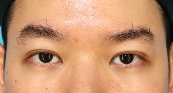 二重まぶた全切開法で自然な末広型二重を作った30代男性の症例写真,After（2ヶ月後）,ba_sekkai106_a01.jpg