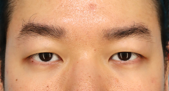 二重まぶた全切開法で自然な末広型二重を作った30代男性の症例写真,Before,ba_sekkai107_b01.jpg