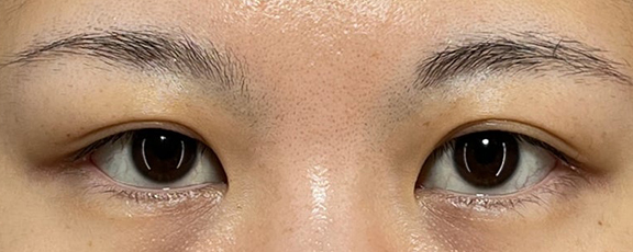 右目は眼瞼下垂、左目は二重まぶた・全切開法を行った症例写真,Before,ba_ganken050_b01.jpg