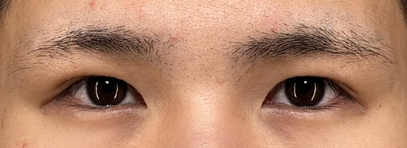 二重全切開＋目頭切開＋目尻切開の症例写真,Before,ba_sekkai108_b01.jpg