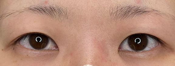 二重全切開法でしっかり幅のある二重を作った症例写真,Before,ba_sekkai109_b01.jpg