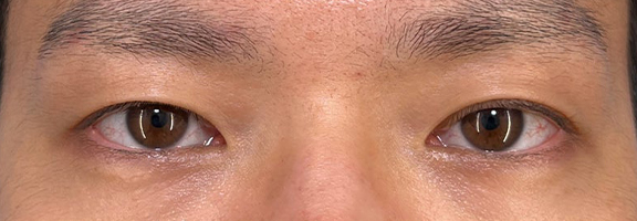 眼球位置の左右差を二重埋没法（一針固定）で調整した症例写真,Before,ba_maibotsu084_b01.jpg