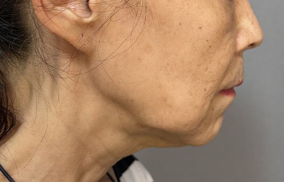 ミニフェイスリフト（頬のたるみ取り）を行い、顎とフェイスラインを引き締めた70代女性の症例写真,Before,ba_minilift024_b01.jpg