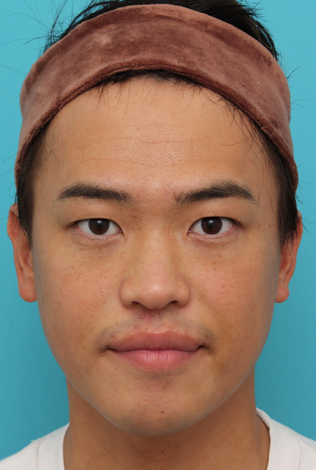 症例写真,埋没法二針固定で自然な末広型二重を作った30代男性の症例写真,手術前,mainpic_maibotsu085a.jpg