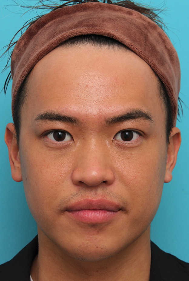 症例写真,埋没法二針固定で自然な末広型二重を作った30代男性の症例写真,3ヶ月後,mainpic_maibotsu085d.jpg