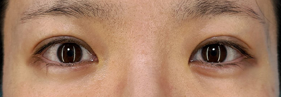二重まぶた・埋没法（二針固定）を行い、1ヶ月後の症例写真,After（1ヶ月後）,ba_maibotsu086_a01.jpg