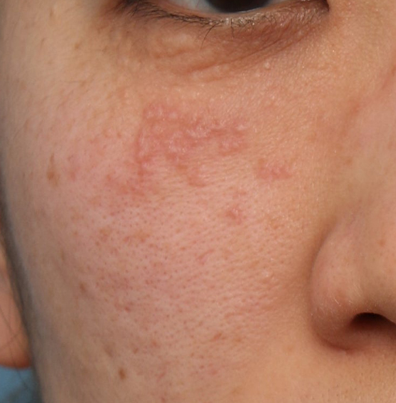 ポテンツァで汗管腫治療を行った症例写真,Before,ba_potenza008_b01.jpg