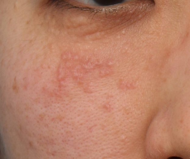 症例写真,ポテンツァで汗管腫治療を行った症例写真,術前,mainpic_potenza008a.jpg