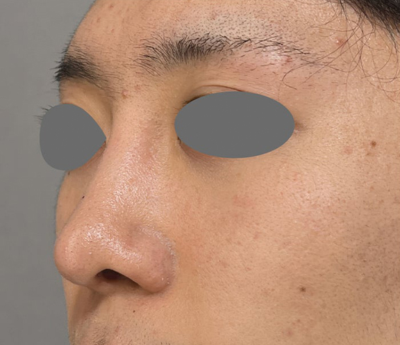 鼻尖形成＋耳介軟骨移植で鼻の高さを出した症例写真,After（3ヶ月後）,ba_bisen032_a01.jpg