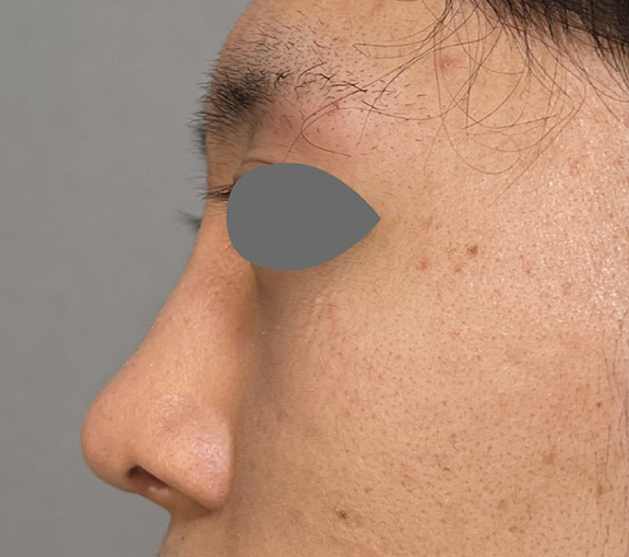 症例写真,鼻尖形成＋耳介軟骨移植で鼻の高さを出した症例写真,After（3ヶ月後）,ba_bisen032_b02.jpg