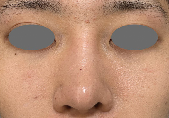 症例写真,鼻尖形成＋耳介軟骨移植で鼻の高さを出した症例写真,After（3ヶ月後）,ba_bisen032_b03.jpg