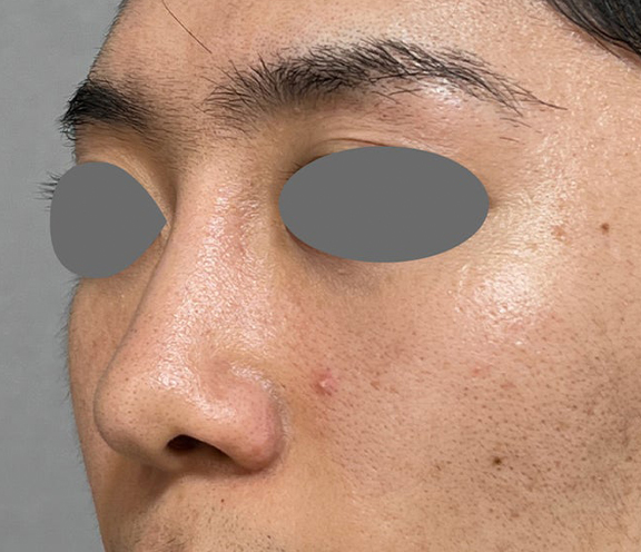 鼻尖形成＋耳介軟骨移植で鼻の高さを出した症例写真,Before,ba_bisen032_b01.jpg