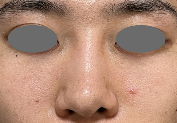 症例写真,鼻尖形成＋耳介軟骨移植で鼻の高さを出した症例写真,Before,ba_bisen032_b03.jpg